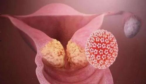 感染hpv吃瓜